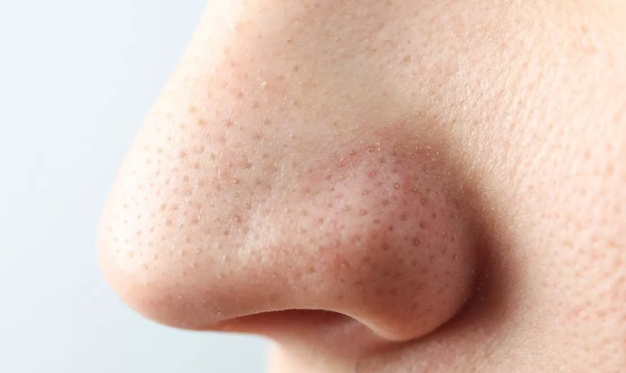 Skin doctor warns never to use pore strips to remove nose blackheads