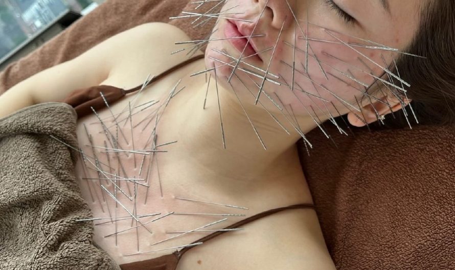 Acupuncture Craze Turns You into a Human Porcupine—But People Love It