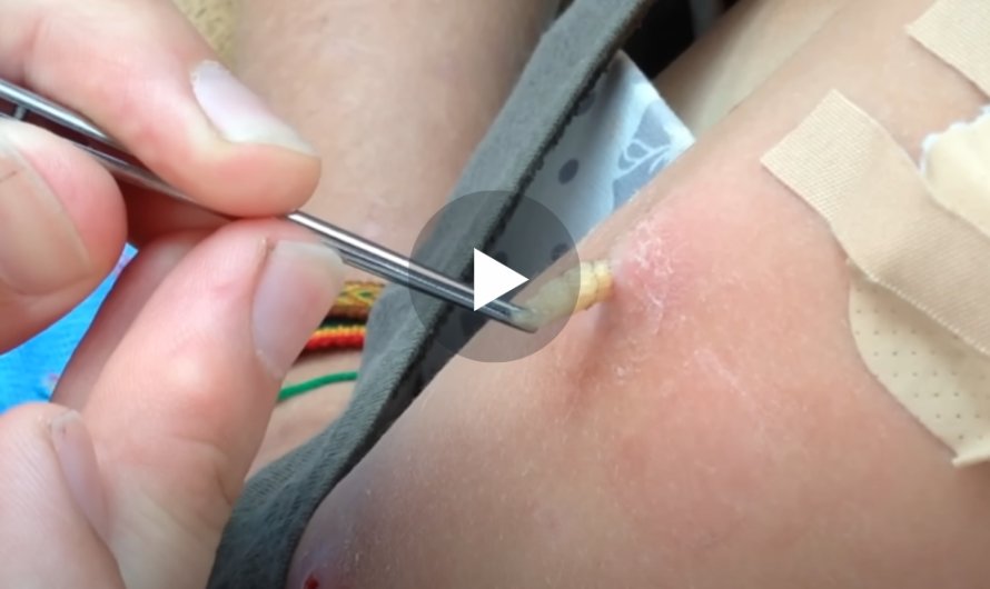 Botfly Maggot Removal