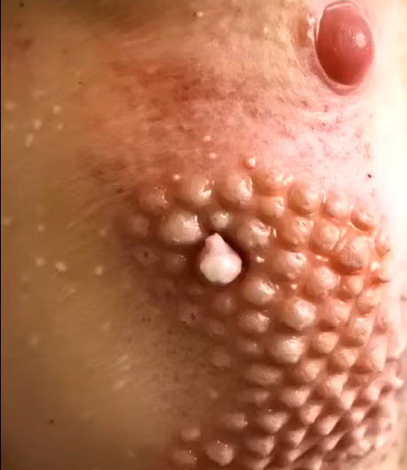 GIANT blackhead removal!