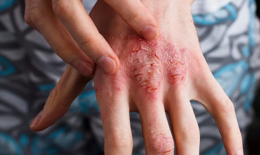 5 Most Common Atopic Dermatitis Causes You Should Be Aware Of