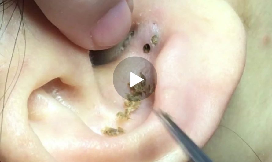 Giant ear acne – Blackhead Acne Removal