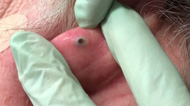 All-Time Best Pimple-Popping Videos You’ll Find Anywhere on the Internet