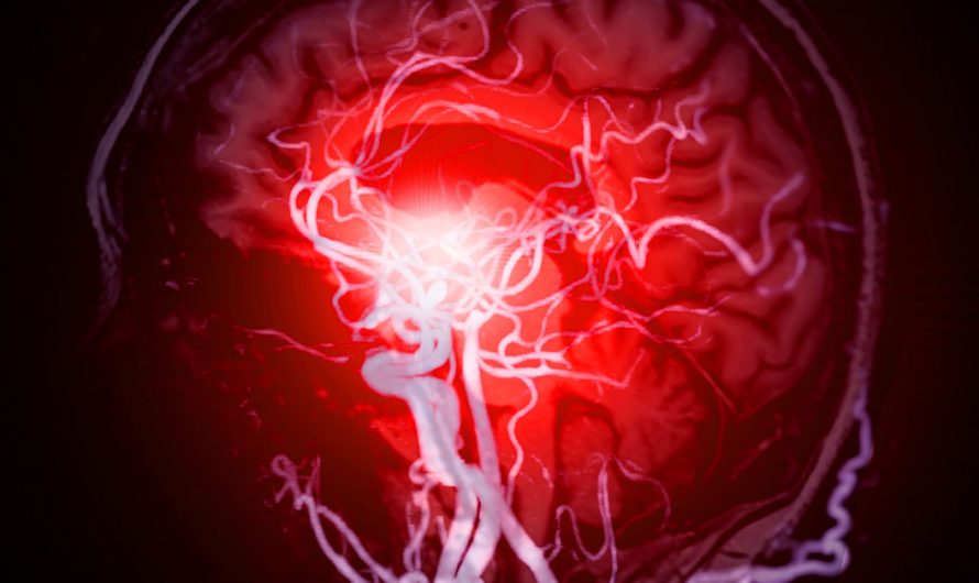 12 Early Warning Signs of an Aneurysm You Shouldn’t Ignore