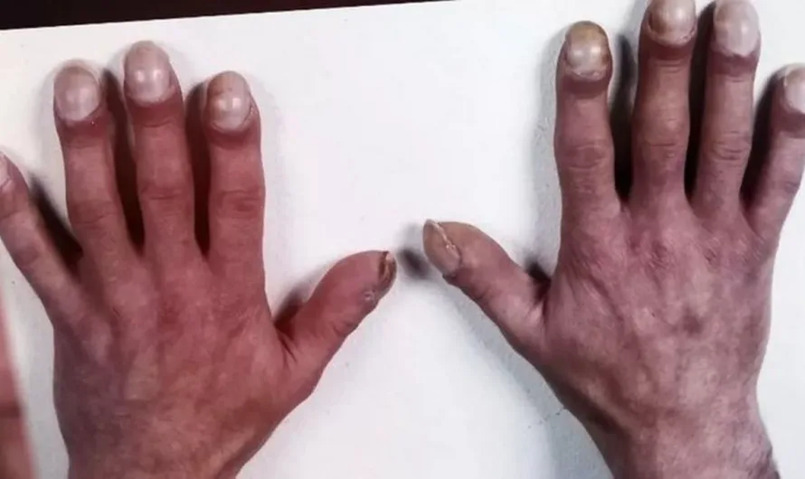 Hands of German serial killer Fritz Honka
