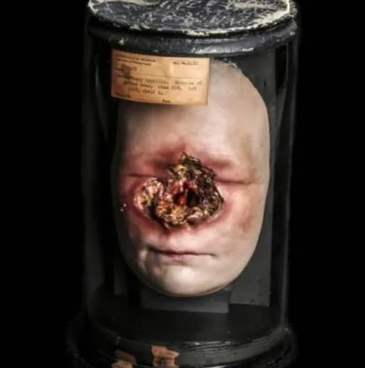 Unveiling the Past – The Syphilis Specimen Story