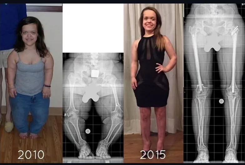 Chandler Crews’ Transformative Journey with Limb-Lengthening Surgery