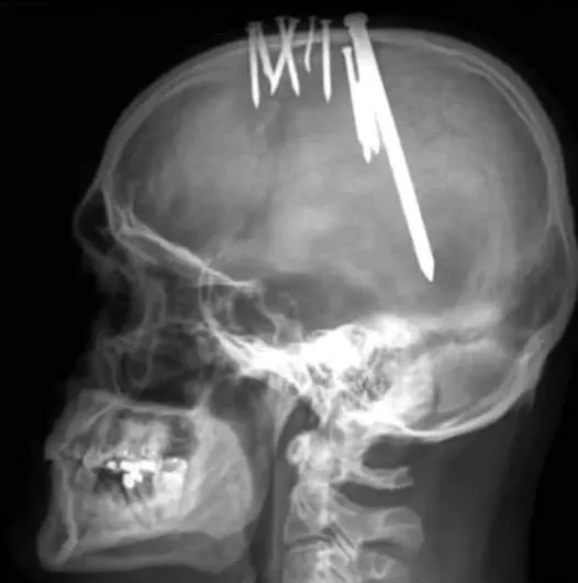 The Unthinkable X-Ray: A Story of Silence, Suffering, and a Cry for Help