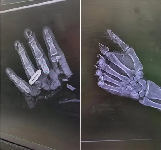 The Accident That Turned a Ring Into a Trap