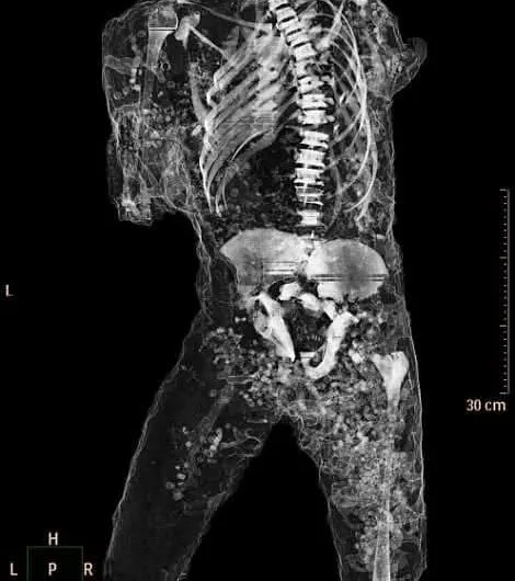Inside the Bodies of Pompeii: What CT Scans Reveal About the Plaster Casts