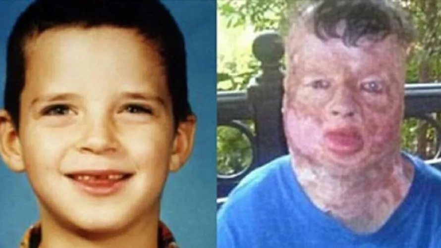 Boy tied to tree and set on fire on 8th birthday exposed killer from deathbed