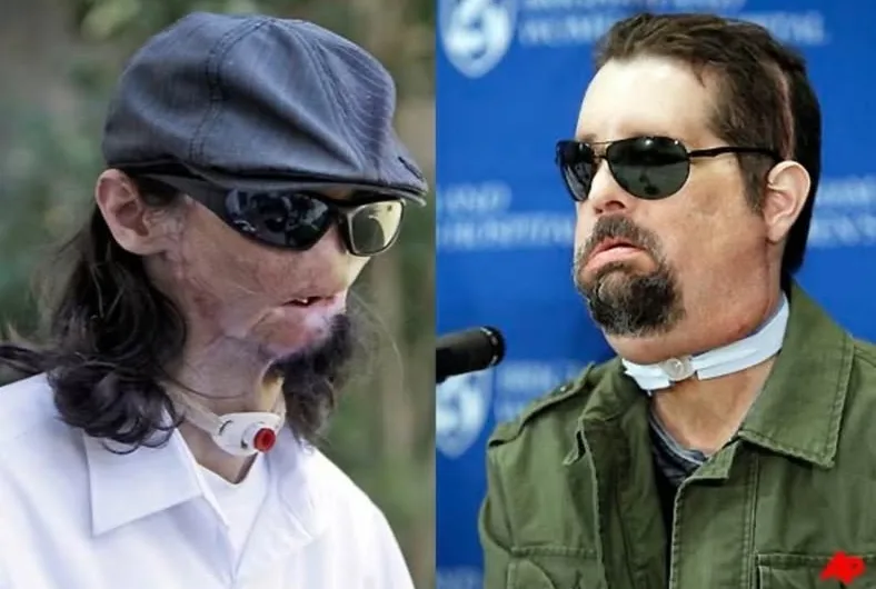 The Man Who Lost His Face — And Got a New One