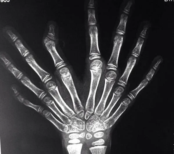 Ulnar Dimelia: The Extraordinary Mirror Hand Syndrome