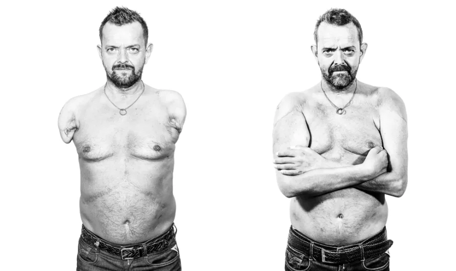 Felix Gretarsson was meant to die after being electrocuted and losing both arms. Instead, he made history