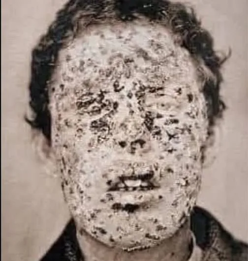 The Virus That Nearly Erased Humanity — Until Humanity Erased It