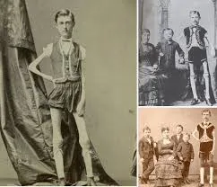 Isaac Sprague: The Living Human Skeleton (1841–1887)