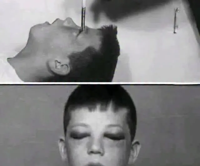 Howard Dully: The Boy Who Survived Walter Freeman’s Ice-Pick Lobotomy